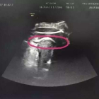 L'ecografia mostrava els peus del nadó fora de l'úter.