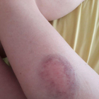 Imatge d'una de les ferides arran de les carregues policials el passat dissabte.