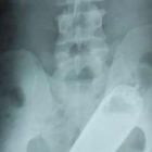 Radiografia practicada a un pacient que tenia un perfum en el recte.
