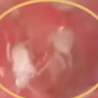 Imagen de algunas de las cucarachas que encontraron dentro de la oreja del paciente