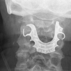 Radiografía frontal de la garganta del paciente.