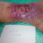 Imatge d'una ferida crònica al peu