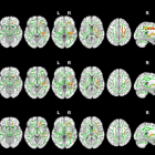 Imatge de ressonància magnètica per comprovar l'efecte de l'insomni en la substància blanca cerebral.