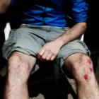 Heridas en las piernas del joven de Riudecanyes.