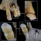 Dentición del individuo 90 de Castellón Alto con evidencias de uso paramasticatorio de la dentición.