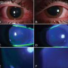 Imatge dels ulls d'un pacient que pateix fotoqueratitis a causa de l'exposició a un llum germicida.