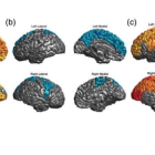Imagen obtenida por Resonancia Magnética del cerebro de pacientes con trastorno bipolar.
