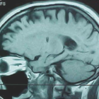 Resonancia magnética de un cerebro en el que se aprecia un tumor. / EFE