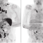 Comparación entre la tomografía computerizada del paciente antes del covid 19 (izquierda) y después (derecha).