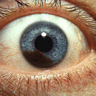 Imagen de un melanoma en el iris de un ojo.