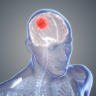 El fármaco se ha demostrado eficaz contra el tumor cerebral más común, el glioblastoma.