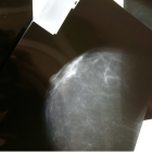 Imatge d'una mamografia.