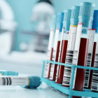 Los test de biomarcadores pueden beneficiar especialmente a pacientes que no reporten los síntomas o cuyo diagnóstico es incierto.