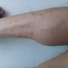 Imatge d’una cama amb diverses mossegades de mosca negra.