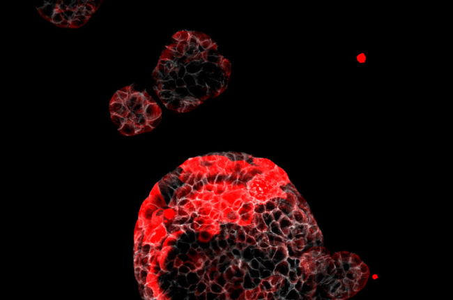 Organoide de càncer colorectal amb cèl·lules residuals responsables de la recaiguda marcades en vermell.