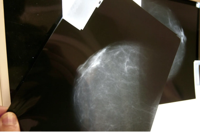 Imagen de una mamografía.