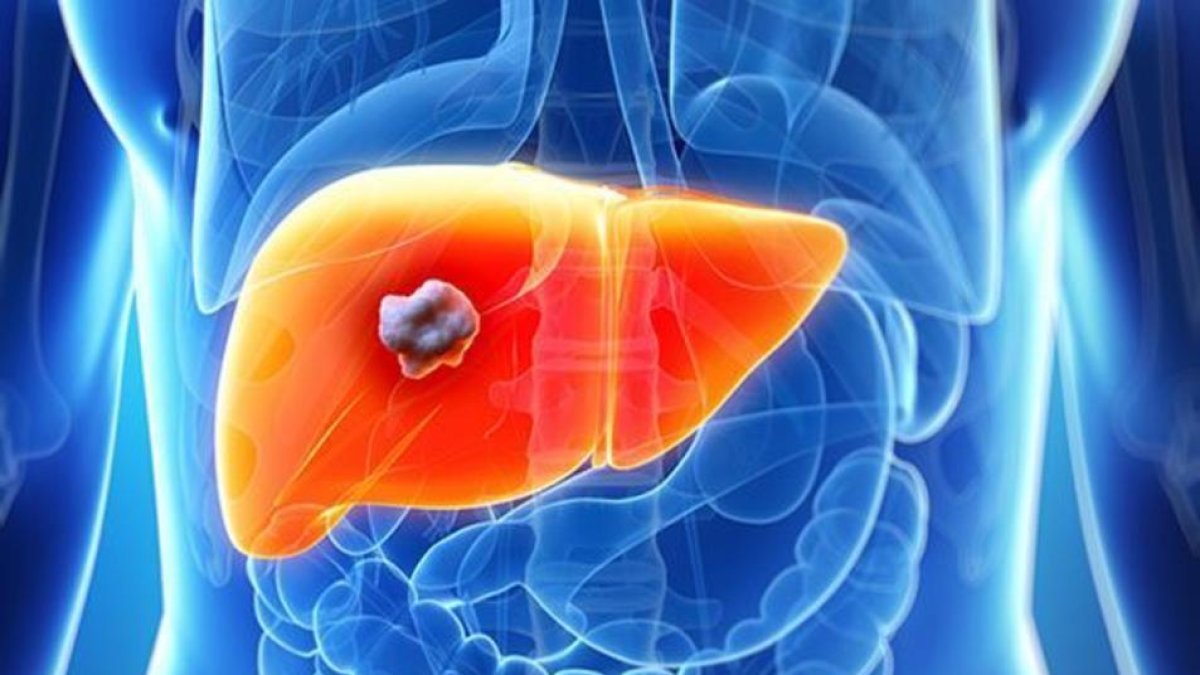 Descifran el papel «protector» de la proteína NOX4 contra el cáncer de hígado