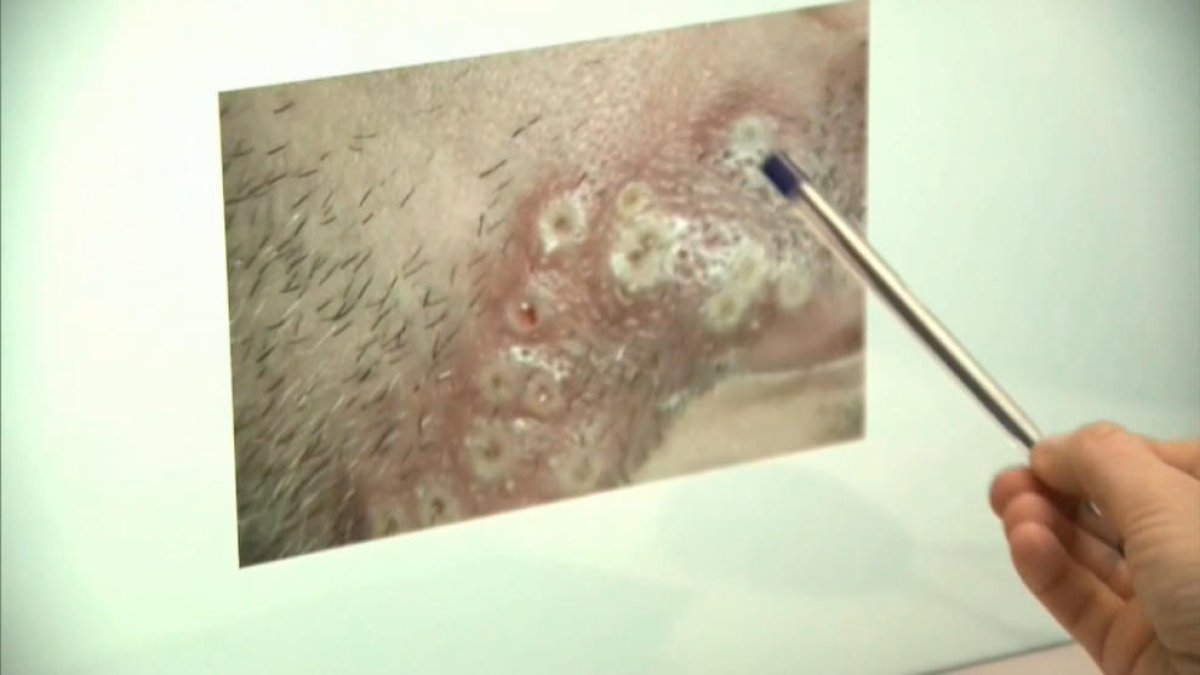 Roche desarrolla tres tests para detectar la viruela del mono