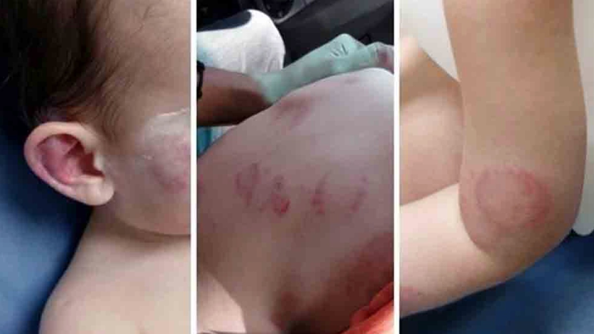 Denuncia a una guardería después de que un niño mordiera 25 veces a su hijo