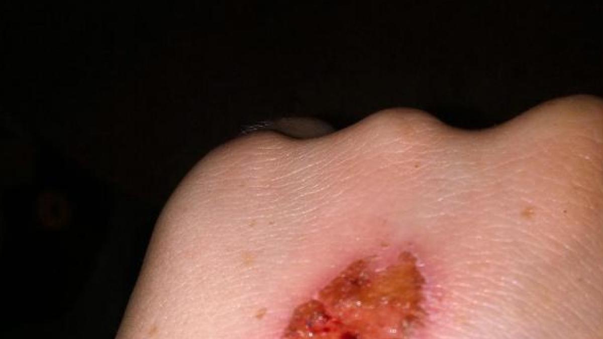 Se extiende por las aulas un nuevo juego infantil que provoca graves heridas en la mano