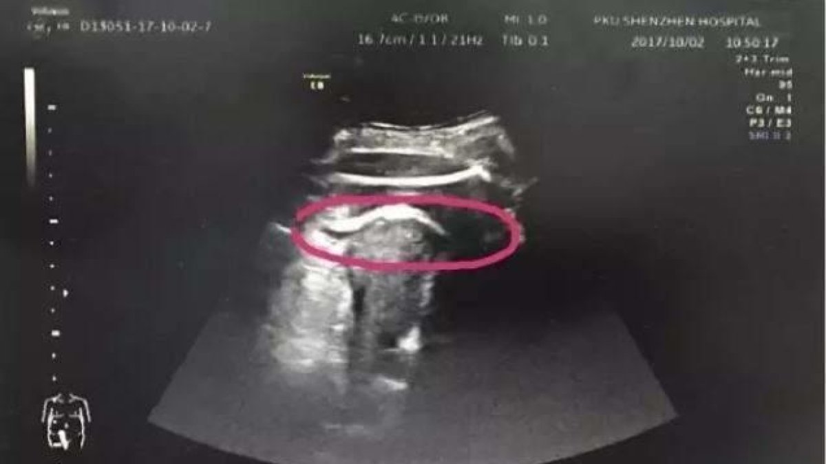 Una embarazada, a punto de perder la vida a causa de una patada de su bebé