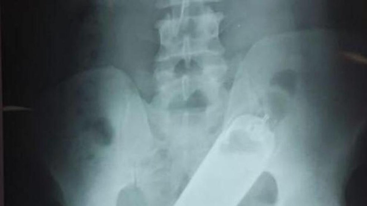 Va al hospital con dolor abdominal y le extraen un frasco de perfume del recto