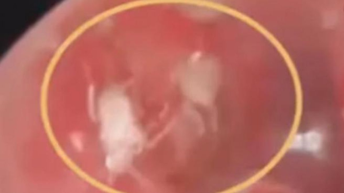 Va a l'hospital per un dolor a l'orella i descobreix que té més d'una dotzena de paneroles dins