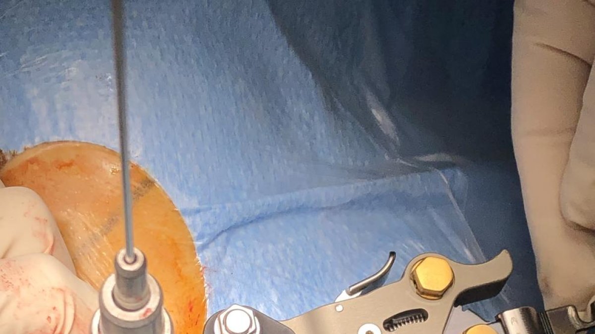 L'equip del Sant Joan realitza tres operacions innovadores de columna