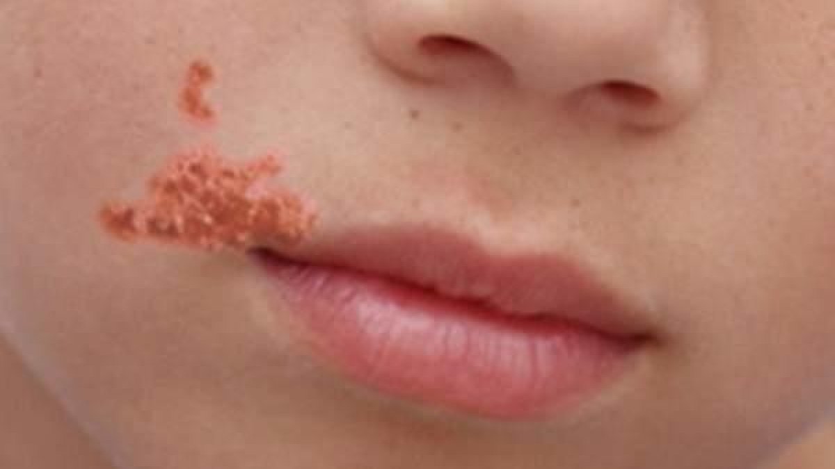 Salud confirma 17 brotes de impétigo en Cataluña, uno en el Ebro