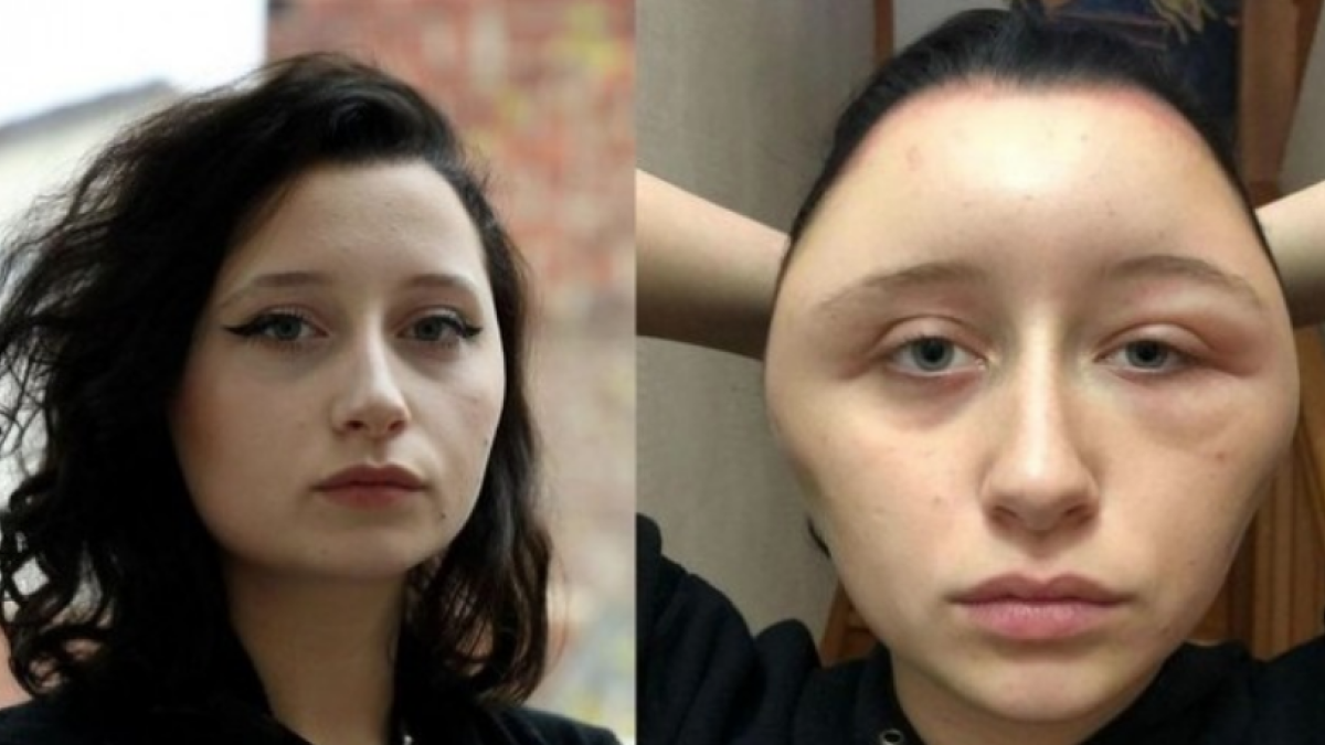 Una chica de 19 años acaba en el hospital con la cara desfigurada después de teñirse