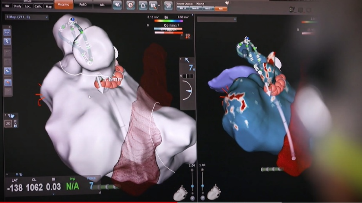 El control del ritmo cardiaco disminuye el riesgo de embolia o infarto en pacientes con fibrilación auricular