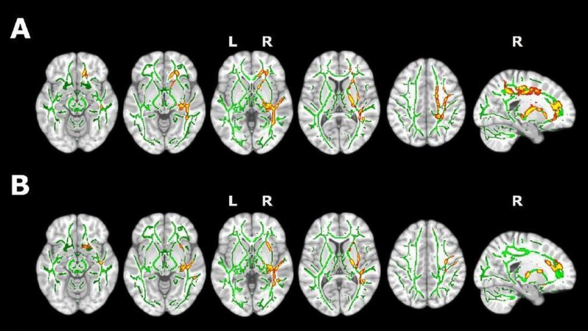 Las personas con insomnio presentan cambios en el rendimiento cognitivo y la estructura cerebral según un estudio