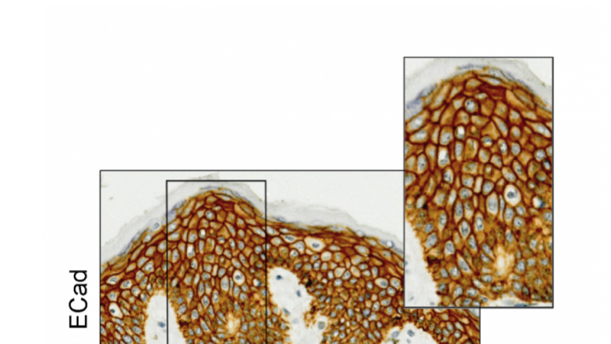 Descubren por qué algunos pacientes de cáncer desarrollan síndrome «mano-pie»