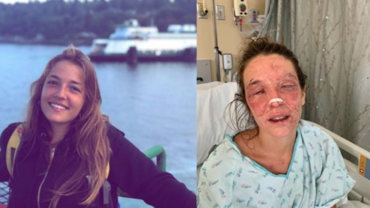 Busquen donacions per salvar els ulls d'una catalana que va patir un accident a Seattle