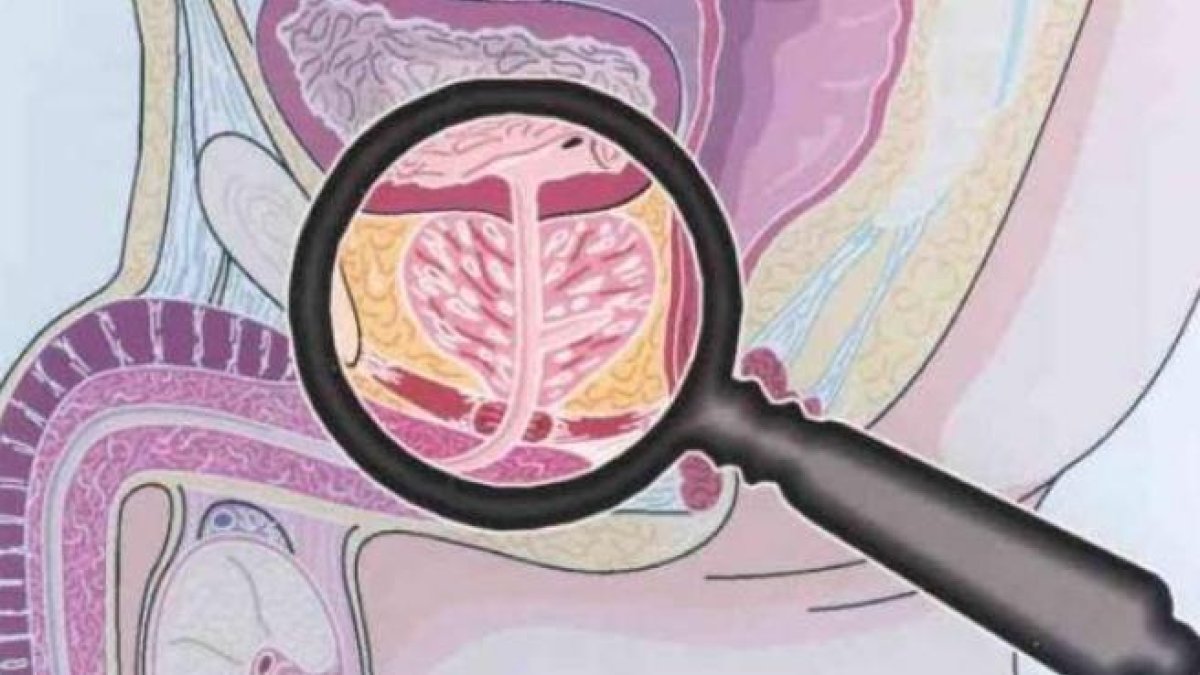 Crean un sistema para detectar en según el cáncer de próstata