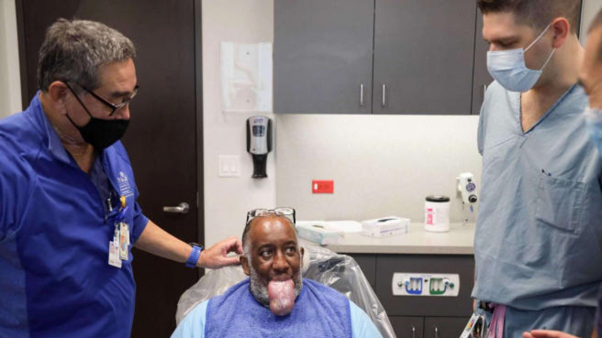 Macroglòssia o llengua gegant: l'estrany símptoma de la covid d'un pacient que no podia parlar o menjar