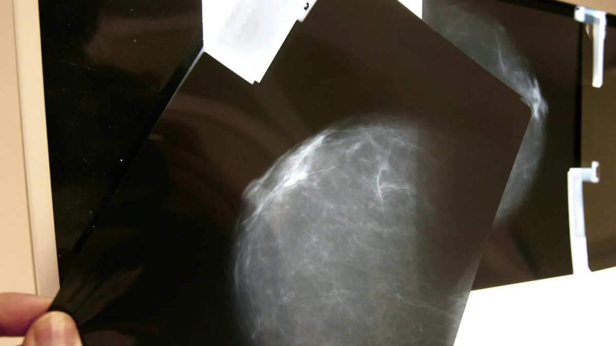 Identifiquen nous biomarcadors de resistència a un dels tractaments contra el càncer de mama