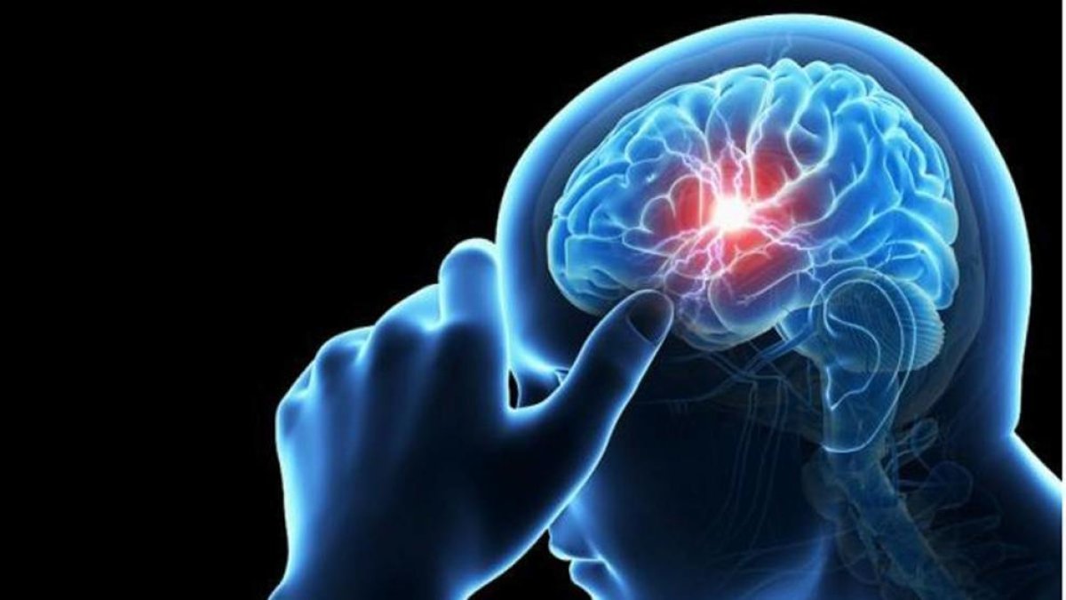 Un estudi internacional descriu 61 nous gens implicats en el risc de desenvolupar un ictus
