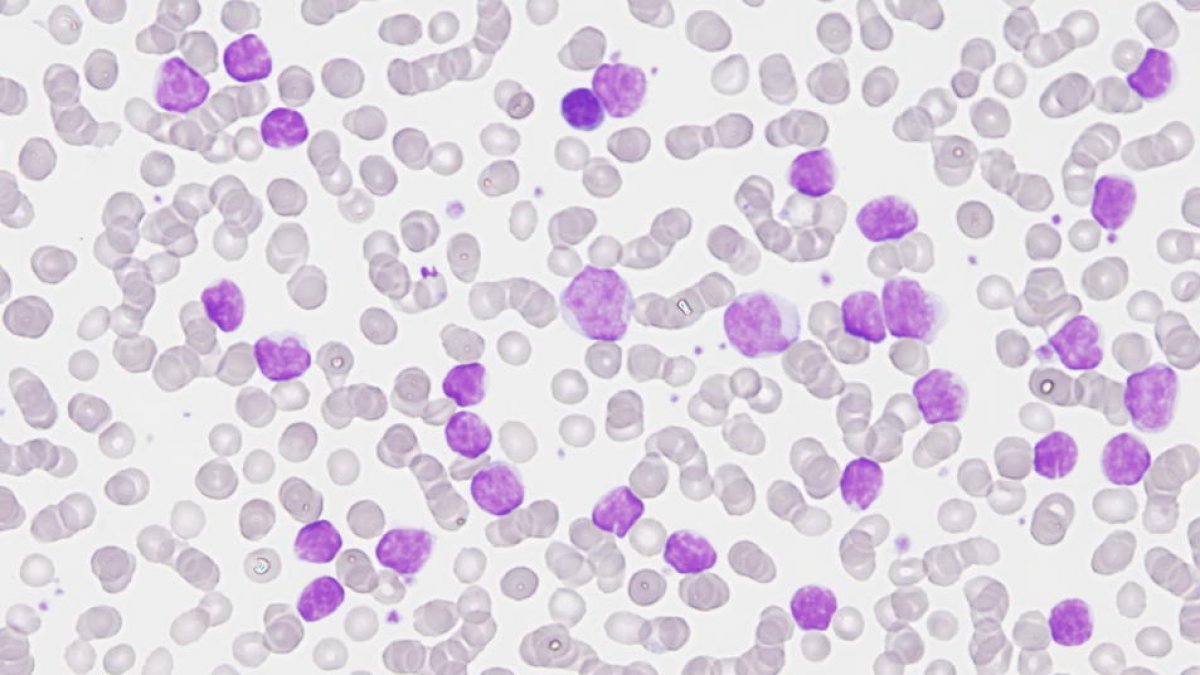 Identifican una vía para superar la resistencia al tratamiento en un tipo de leucemia