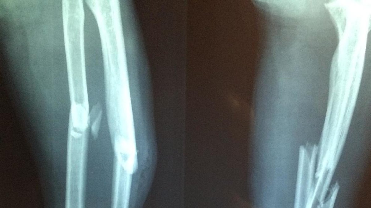 La sorprenent conseqüència de la síndrome de Down en els ossos: no són capaços de sanar fractures