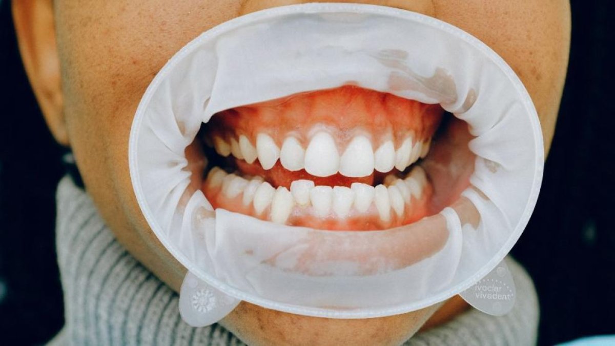 Et sagnen les genives? Aquesta és la greu malaltia que podrien provocar-te