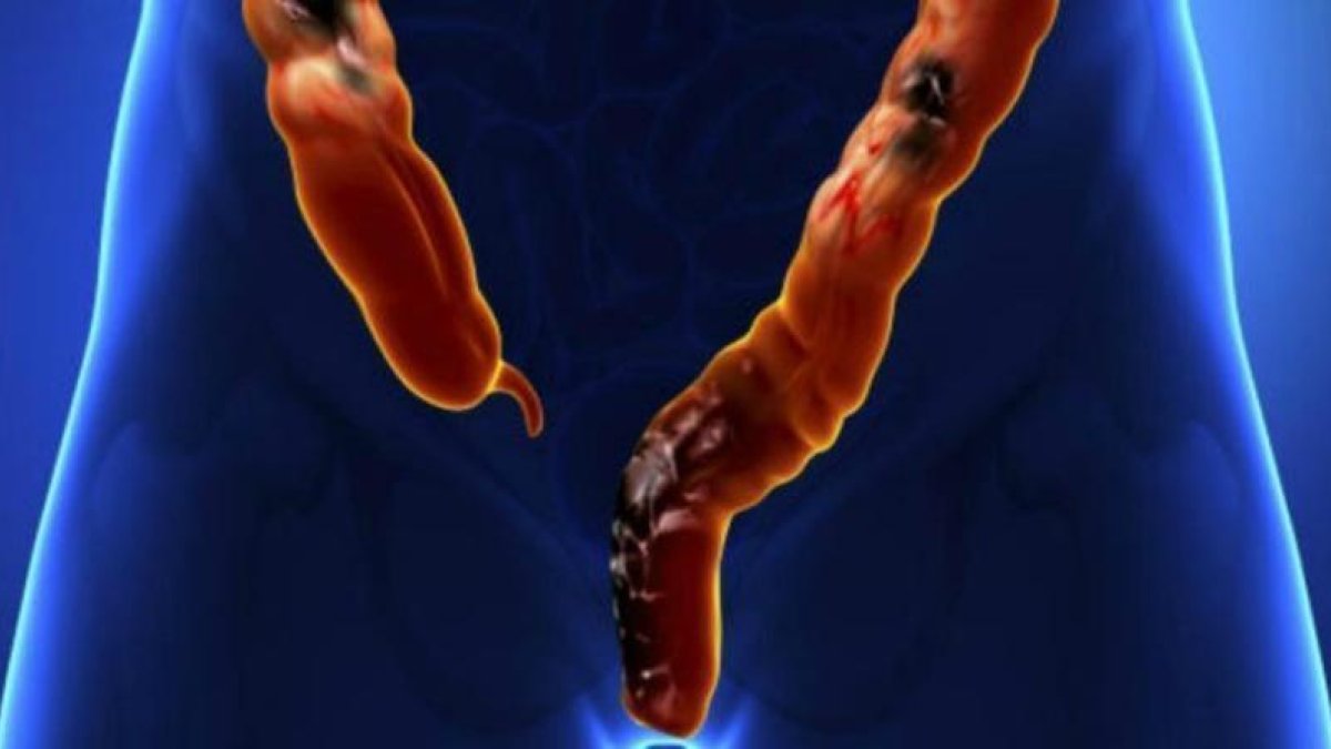 Así ataca y crece el cáncer de colon, según una investigación pionera de expertos de Harvard