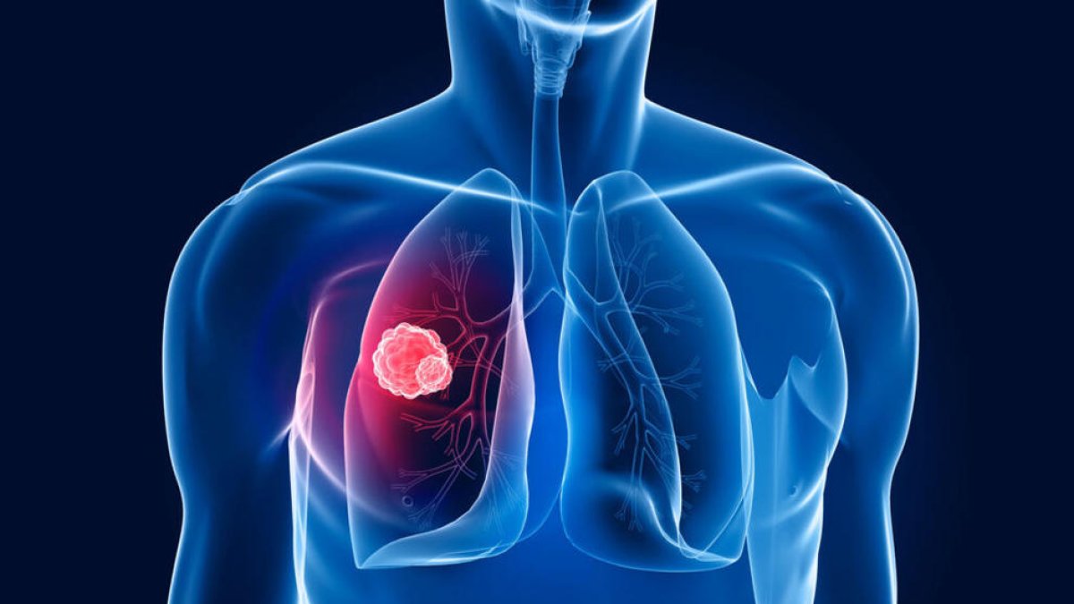 Aquests són els primers signes del càncer de pulmó