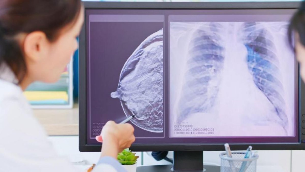 Una dosis menor de un fármaco contra un tipo de cáncer de mama ya es efectiva en un 32% de casos