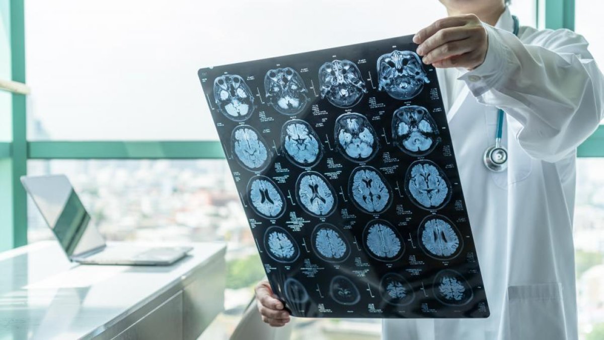 Hallan una nueva vacuna para prevenir el alzhéimer en personas con síndrome de Down