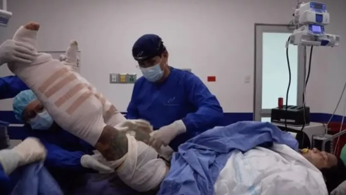 Un 'influencer' se somete a la «operación más dolorosa» para aumentar 6 centímetros su estatura