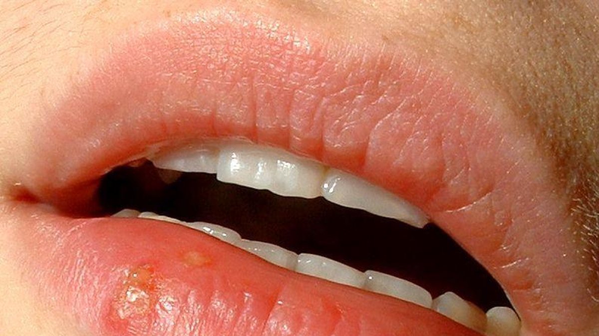 Un estudi revela que glopejar amb col·lutoris amb CPC ajuda a reduir les infeccions pel virus de l'herpes simple
