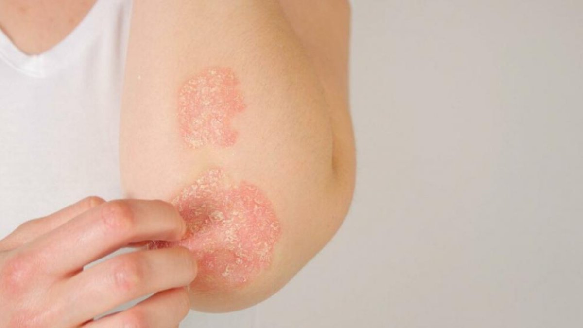 Un estudi confirma que la psoriasi augmenta el risc de malaltia cardíaca