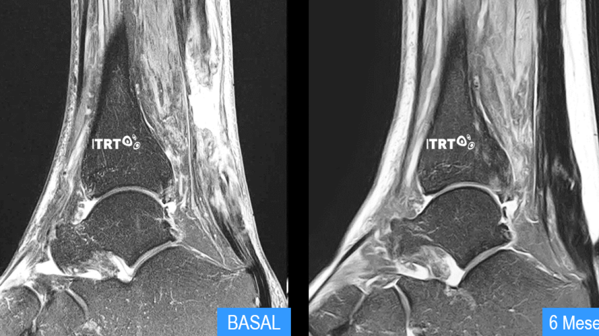 Les células madre mesenquimáticas cultivadas, primera terapia que demuestra científicamente que regenera tendón