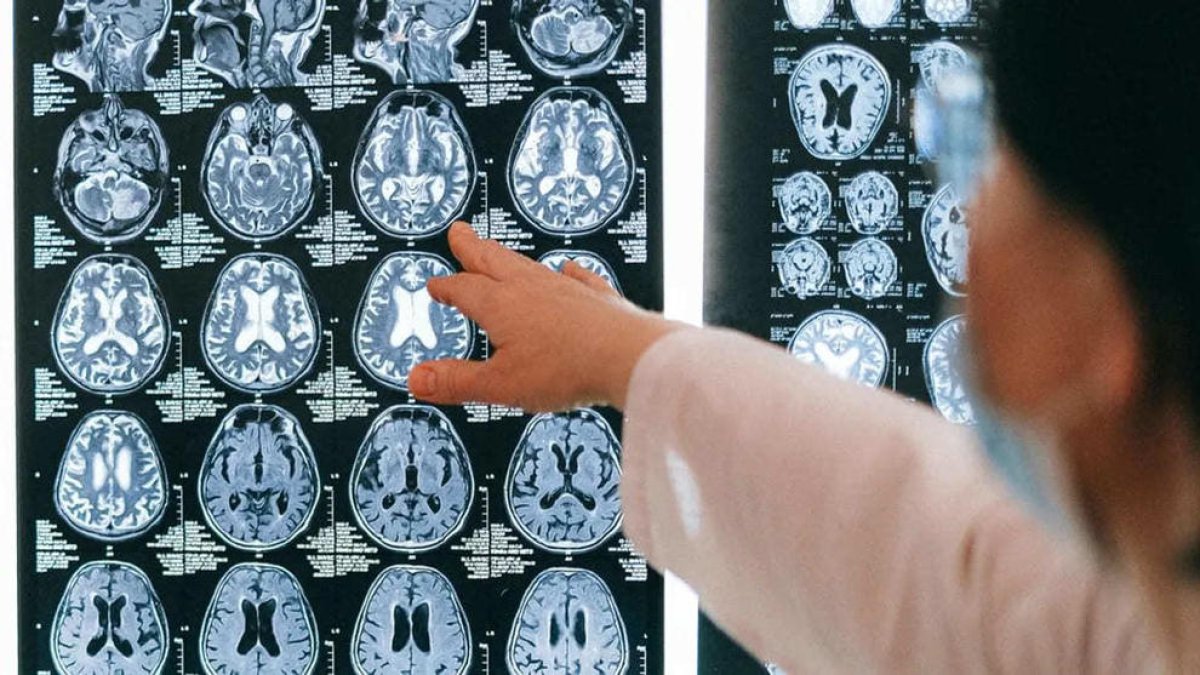 La trombectomia per a ictus només funciona entre setmana al Joan XXIII